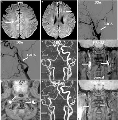 Three-Dimensional High-Resolution Magnetic Resonance Imaging for the Assessment of Cervical Artery Dissection